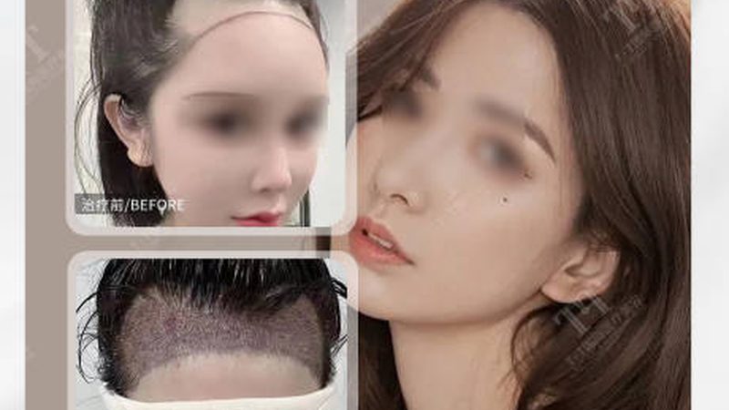 玻尿酸面部填充，揭秘成都热门项目的流程步骤