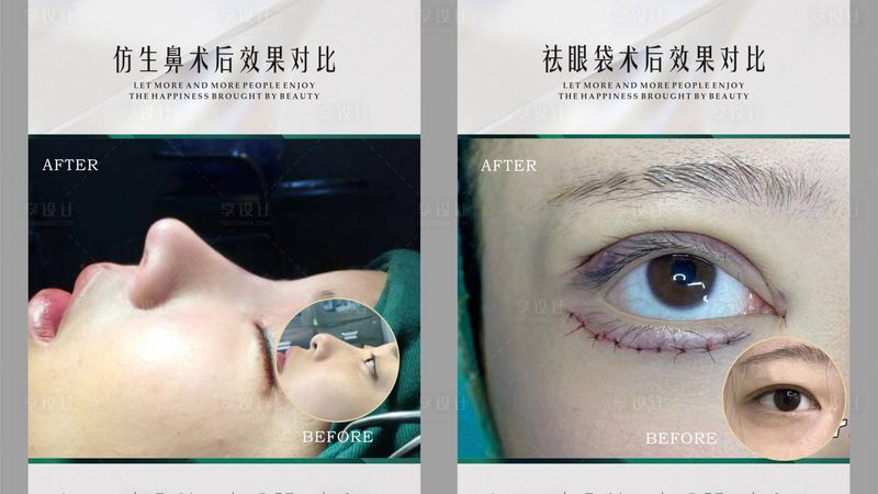 鼻综合整形，术前准备流程揭秘**