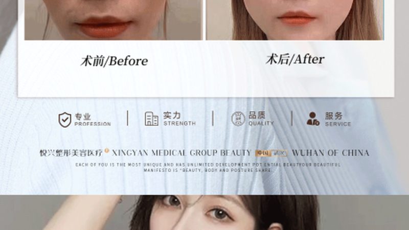 光子嫩肤美容设备加盟，揭秘费用背后的关键因素