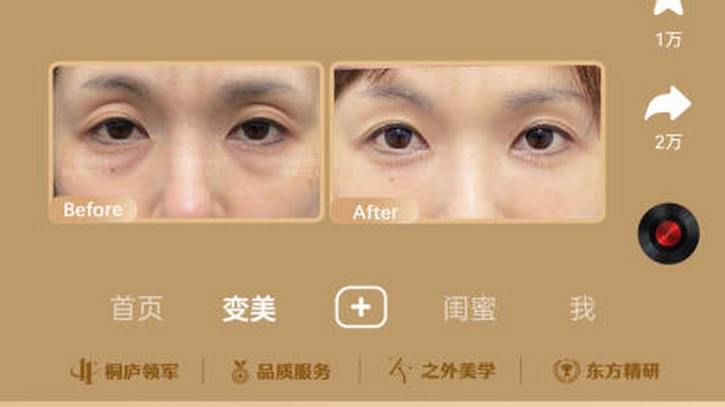 成人斜视肉毒素治疗：原理、方法与注意事项