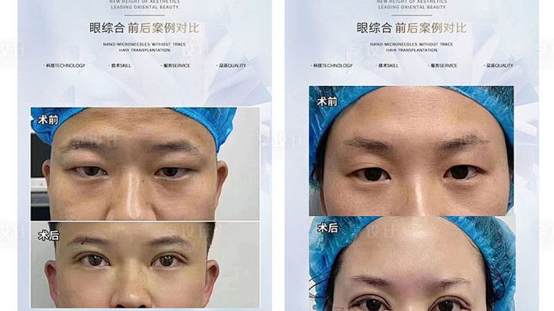 膨体隆鼻术前，你准备好了吗？**