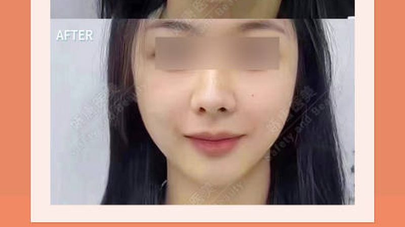双眼皮修复，费用几何？揭秘影响价格的关键因素**