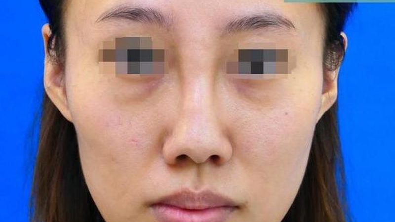 热玛吉五代与四代的价格差，到底值不值